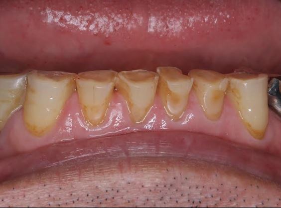 歯がすり減っているのは 歯ぎしり食いしばりが強いからでしょうか 蕨歯科クリニックより